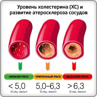 атеросклероз