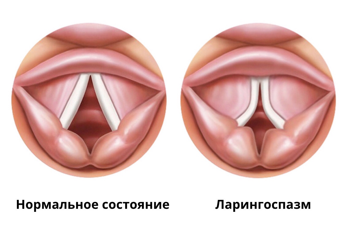 ларингоспазм у детей и взрослых