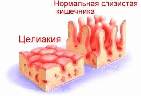 непереносимость глютена
