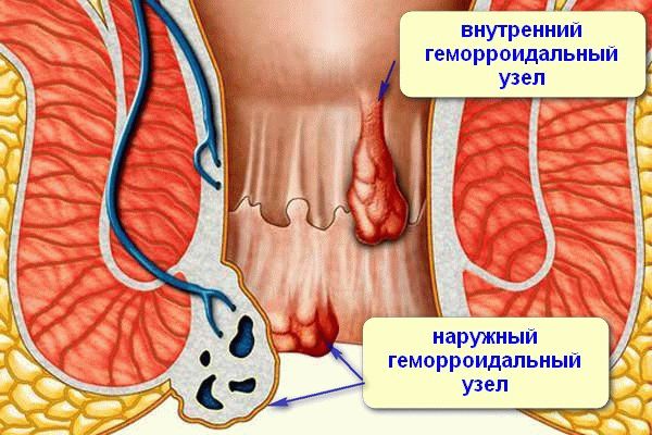 геморроидальные узлы