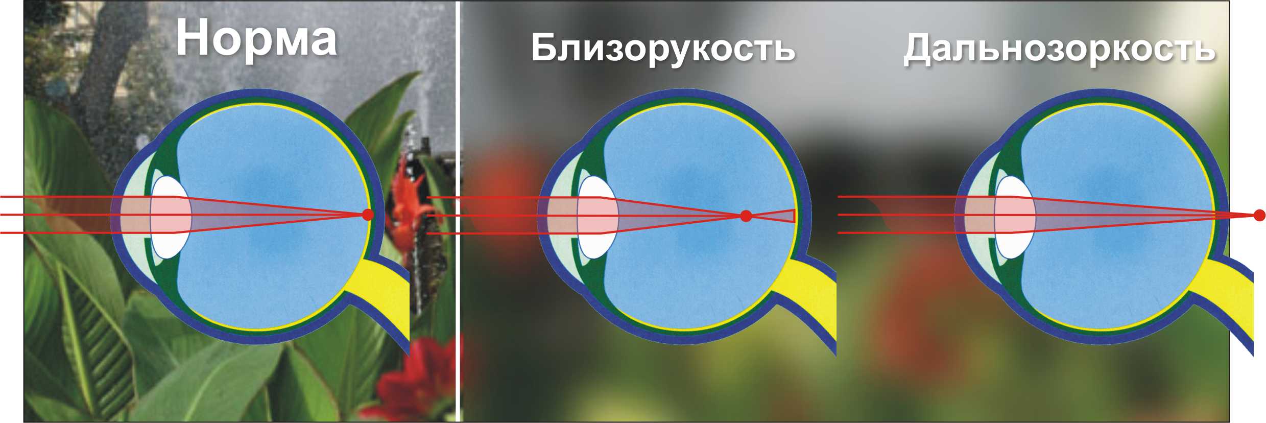 близорукость