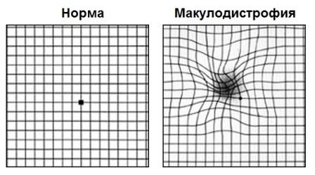 Тест Амслера