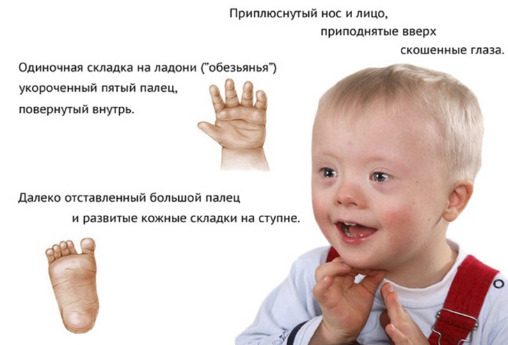 Признаки синдрома Дауна
