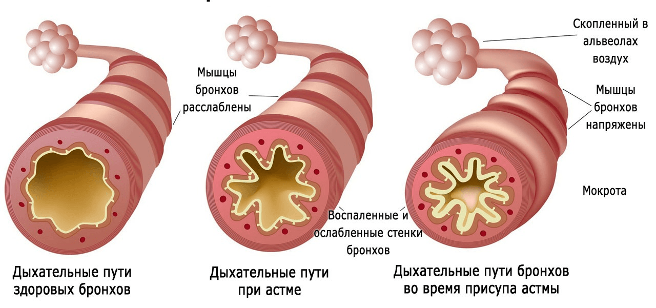 причины астмы